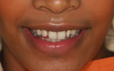Composite veneers before treatment at Lotus Clinic, Golders Green, case two