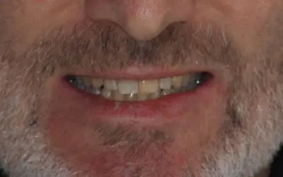 Composite veneers before treatment at Lotus Clinic, Golders Green, case three