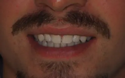 Composite veneers before treatment at Lotus Clinic, Golders Green, case five
