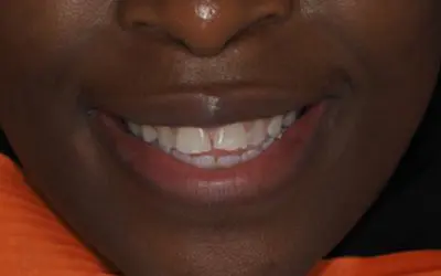 Composite veneers before treatment at Lotus Clinic, Golders Green, case four