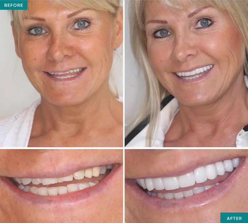 Smile makeover before and after at Lotus Dental and Aesthetics Clinic, Golders Green