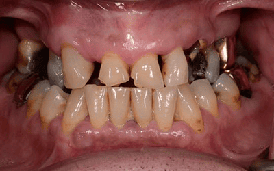 Before All-on-4 dental implant treatment at Lotus Clinic, Golders Green, patient one
