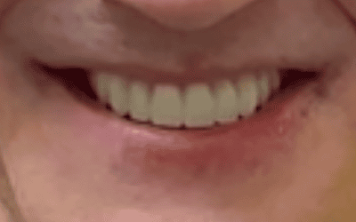 After All-on-4 dental implants, teeth in a day at Lotus Clinic, Golders Green, patient one