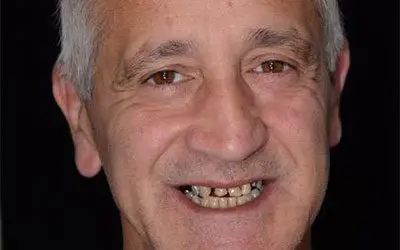 Before All-on-4 dental implant treatment at Lotus Clinic, Golders Green, patient two