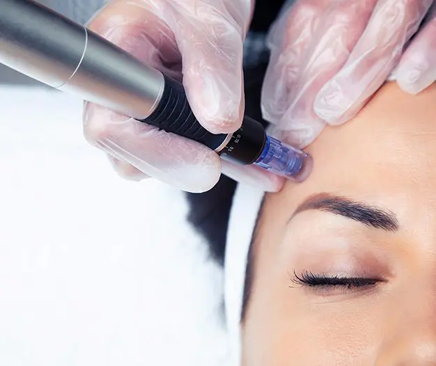 Micro-Needling Treatment in Golders Green, London