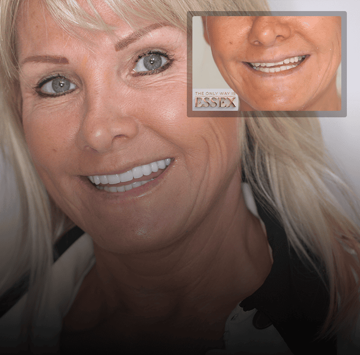 Smile makeover and cosmetic dentistry at Lotus Dental and Aesthetics Clinic, Golders Green