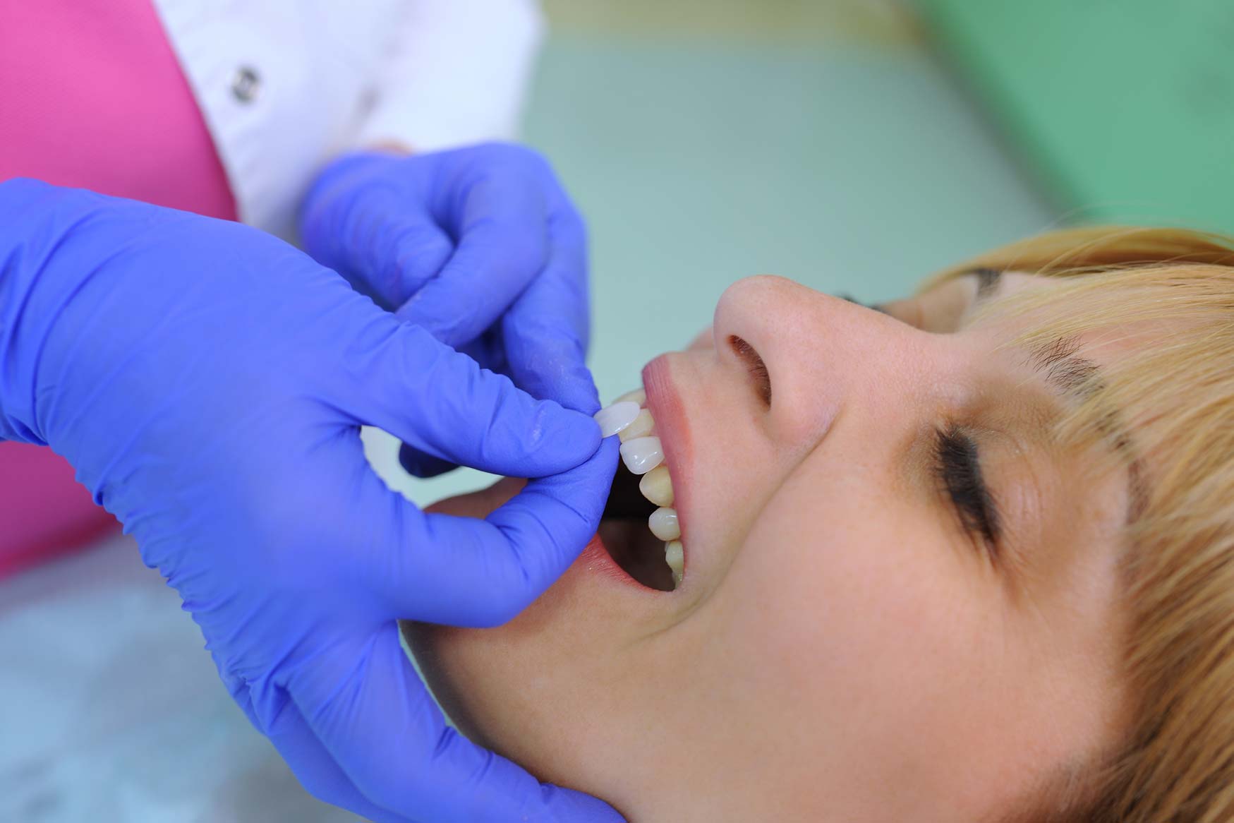 How Veneers Are Placed