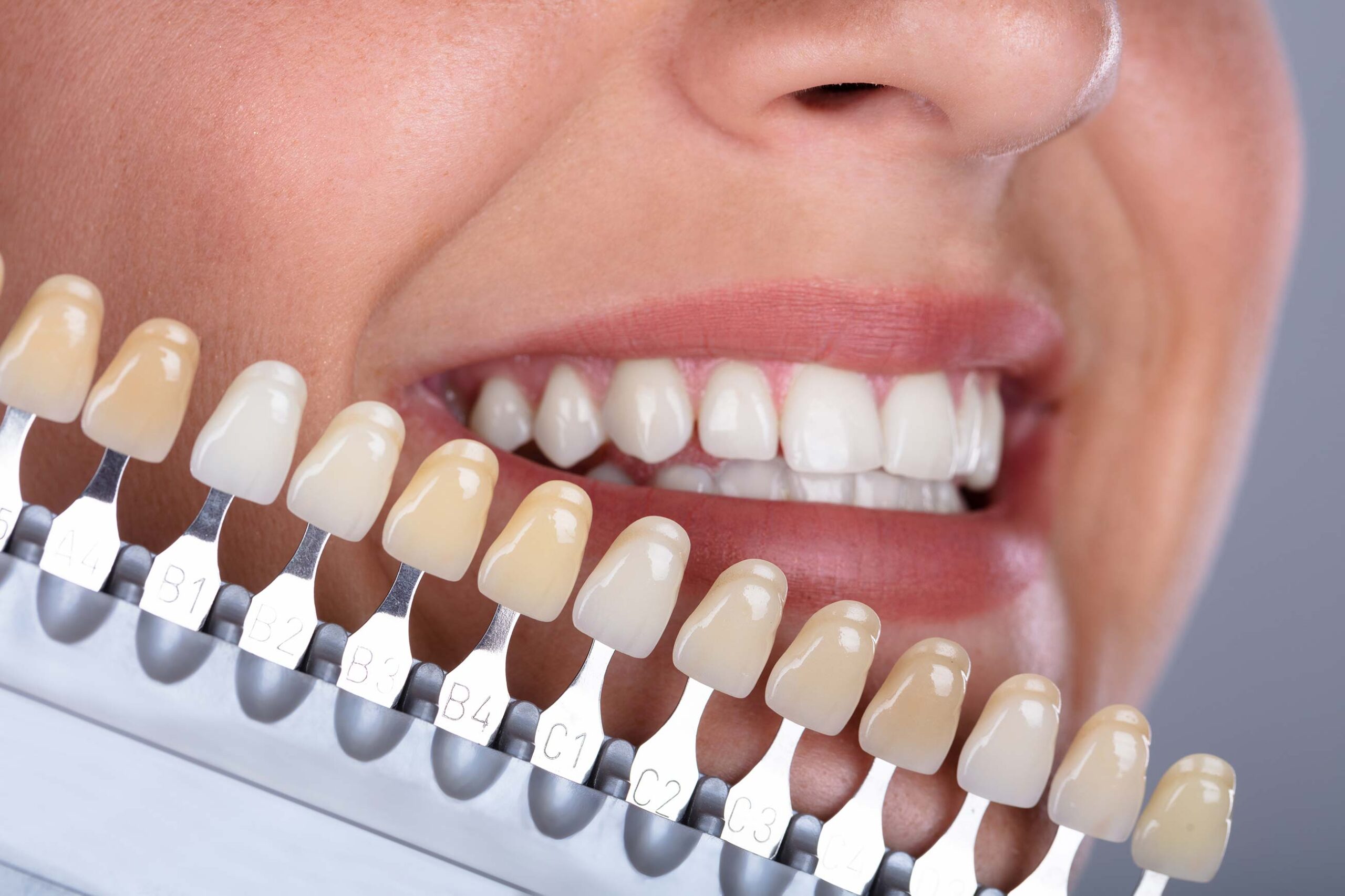 Veneers and Bonding in Golders Green, London
