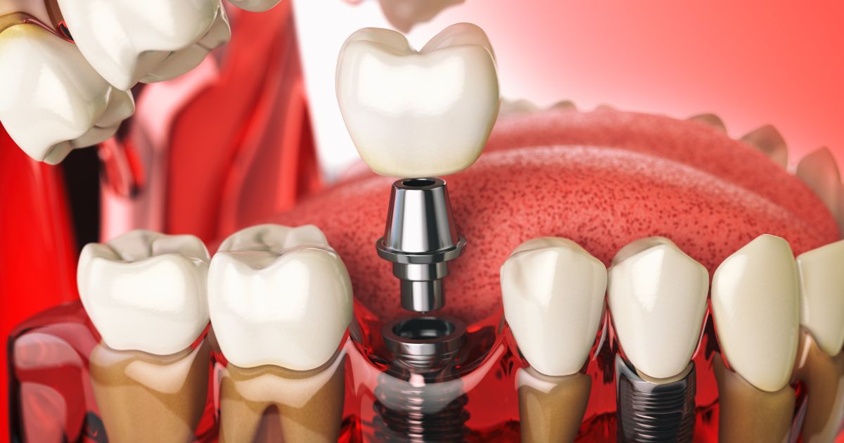 how implants can restore your smile after a major dental accident