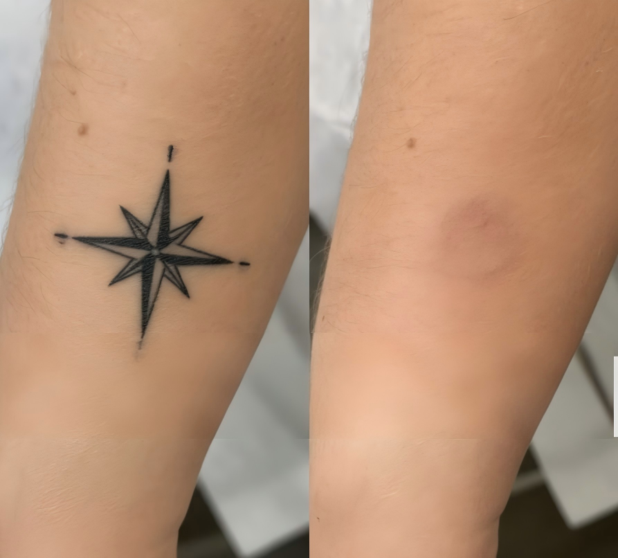 Pico Laser Tattoo Removal