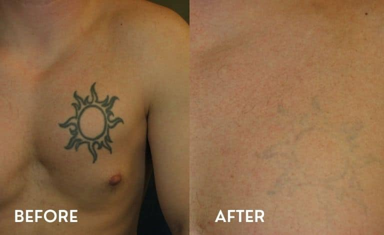 Pico Laser Tattoo Removal