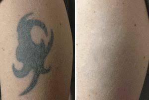 Pico Laser Tattoo Removal