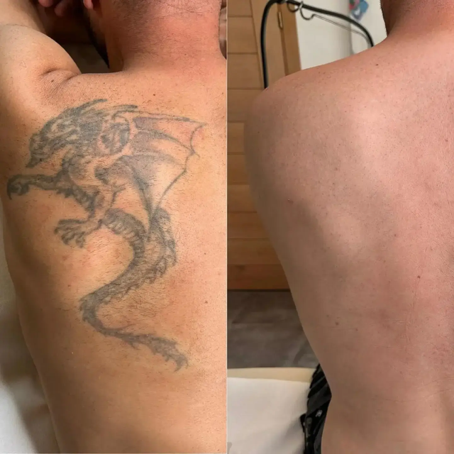 Pico Laser Tattoo Removal
