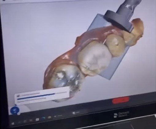 Designing a same-day CEREC crown on screen at Lotus Clinic, Golders Green